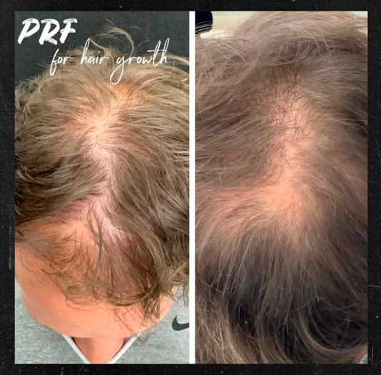 Prf for hair growth